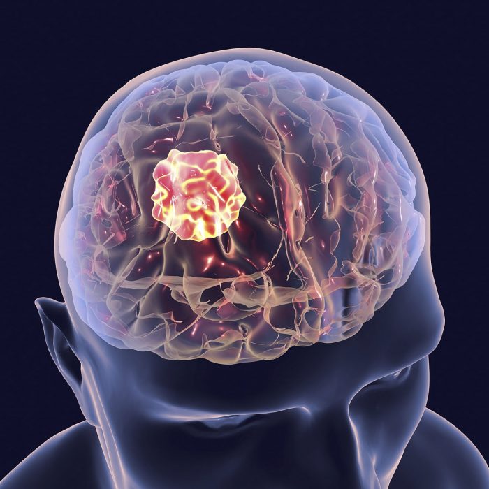 A scientific image of the top of a person's head with a glowing yellow tumour inside the brain area with a black background.